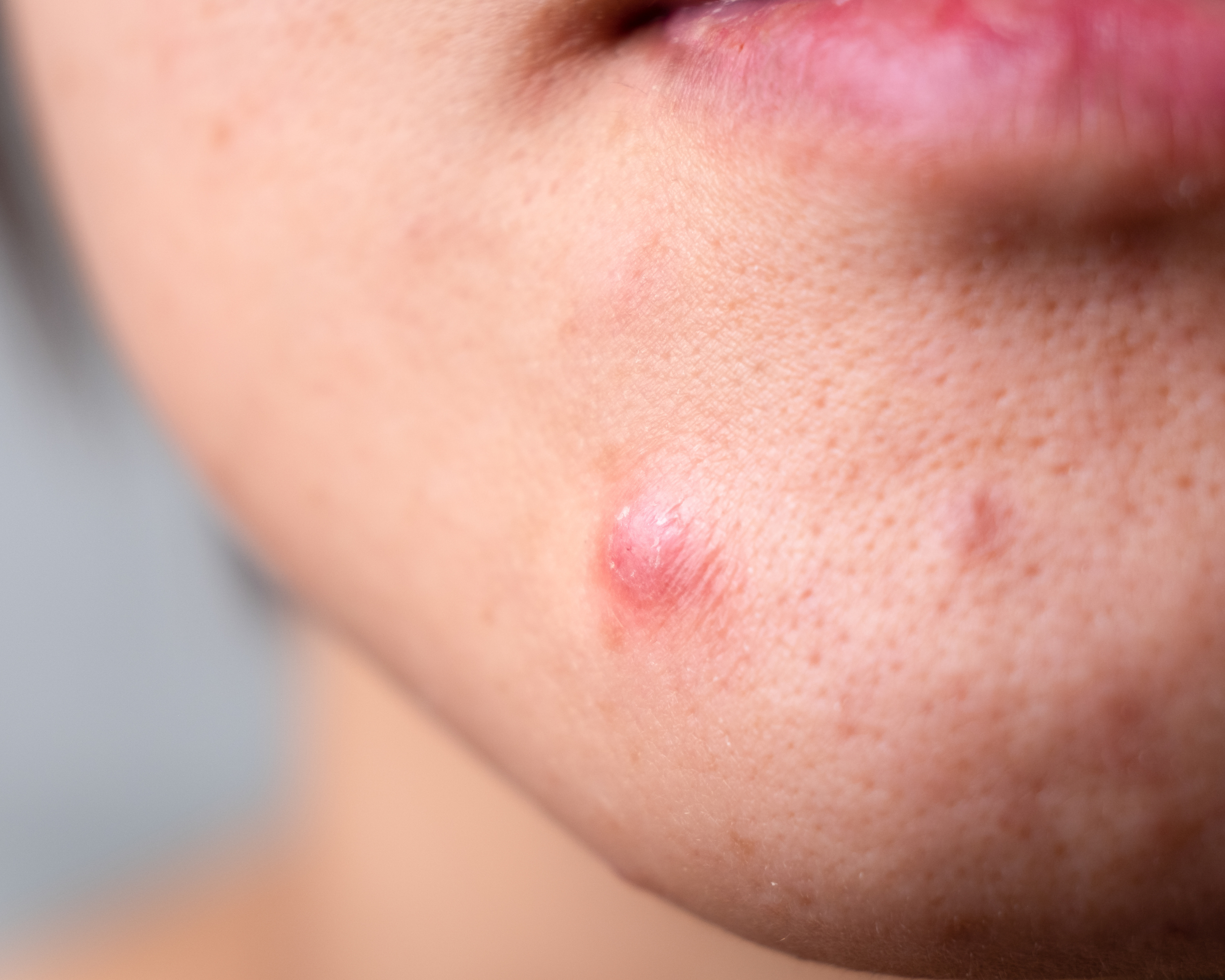 The 3 Most Common Types of Spots and How to Get Rid of Them!