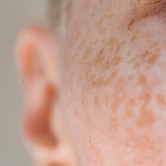 PSF / Empfindliche Haut beruhigen & richtig pflegen