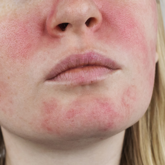 Special care for redness & rosacea