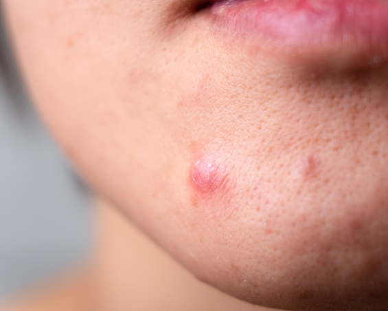 The 3 Most Common Types of Spots and How to Get Rid of Them!